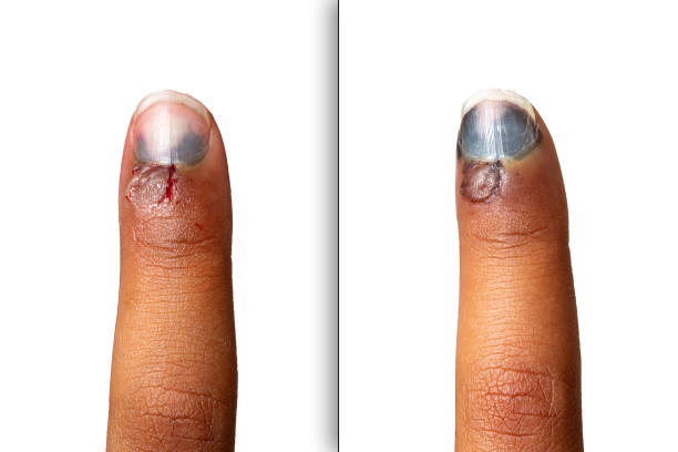 istock evolution of the hematoma of a crushed finger 1609500349
