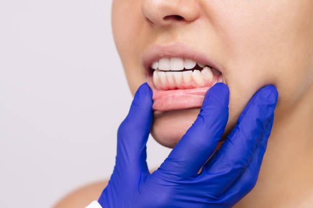 istock Wrong bite. Young woman's face with doctor's hand in a blue glove showing healthy gums. Malocclusion 1609501469