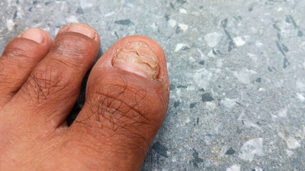 istock Instep, toes, big toe, toenails, toe hairs 1611184285