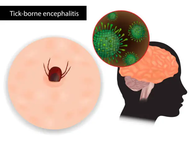 Vector illustration of Tick-borne encephalitis. Viral infectious disease involving the central nervous system. Sheep ticks or Ixodes ricinus
