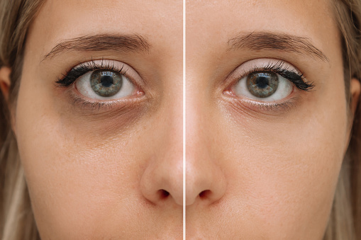 Cropped shot of a young female face. Close-up of female green eyes with dark circles under eyes before and after cosmetic treatment. Bruises under the eyes. Cosmetology concept. Result of therapy