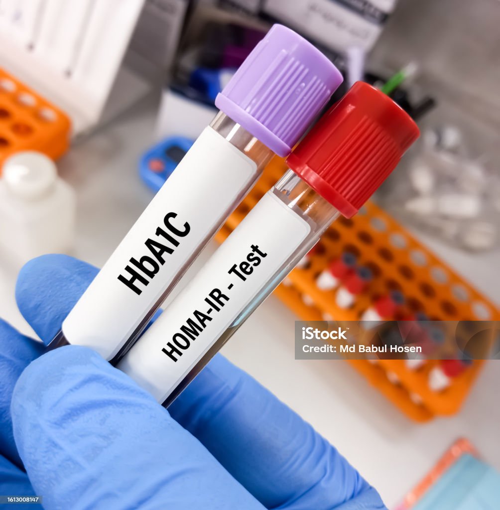 Blood Sample For Homa Ir Test Diabetes Monitoring Test Stock Photo Blood Sample For Homa Ir Test Diabetes Monitoring Test Stock Photo