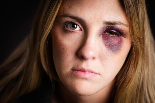A close-up of a pretty young blond woman with a black eye.