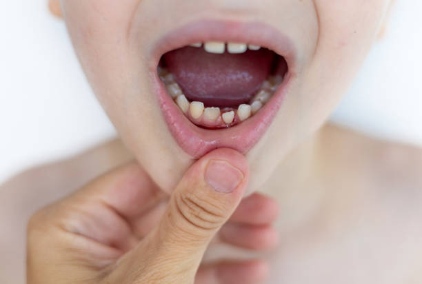 istock falling bloody milk teeth, preschooler kid boy 1613986972