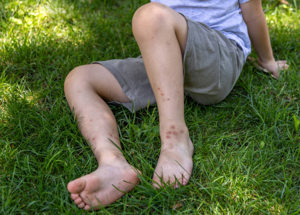 istock kid legs in park with mosquito insects bites 1613986977