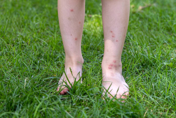 istock kid legs in park with mosquito insects bites 1613986978