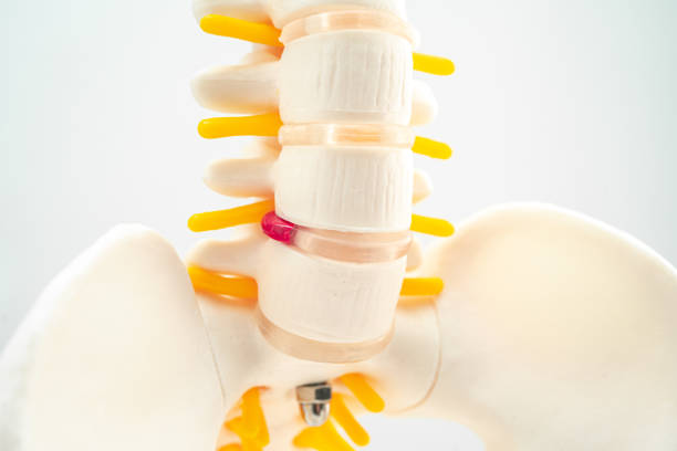 la columna lumbar desplazó el fragmento de hernia discal, el nervio espinal y el hueso. modelo para tratamiento médico en el departamento de ortopedia. - slipped disc fotografías e imágenes de stock