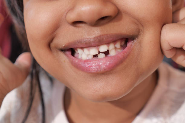 istock detail shot of child with teeth missing 1616253196