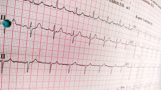 ECG Electrocardiograph paper that shows sinus rhythm abnormality of right ventricular hypertrophy. Cardiac fibrillation. Normal sinus rhythm ECG. Vital sign. Medical healthcare symbol.