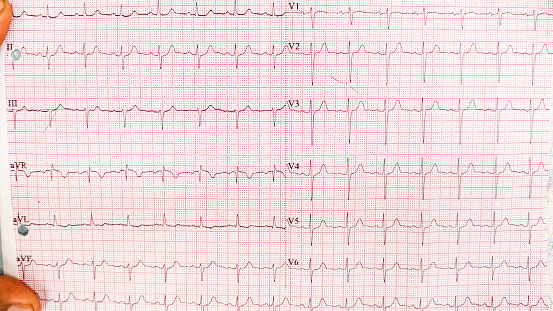 Normal 12-lead sinus rhythm ECG. Electrocardiogram show normal heart beat line (Sinus rhythm). ECG. EKG. Vital sign. Medical healthcare symbol.