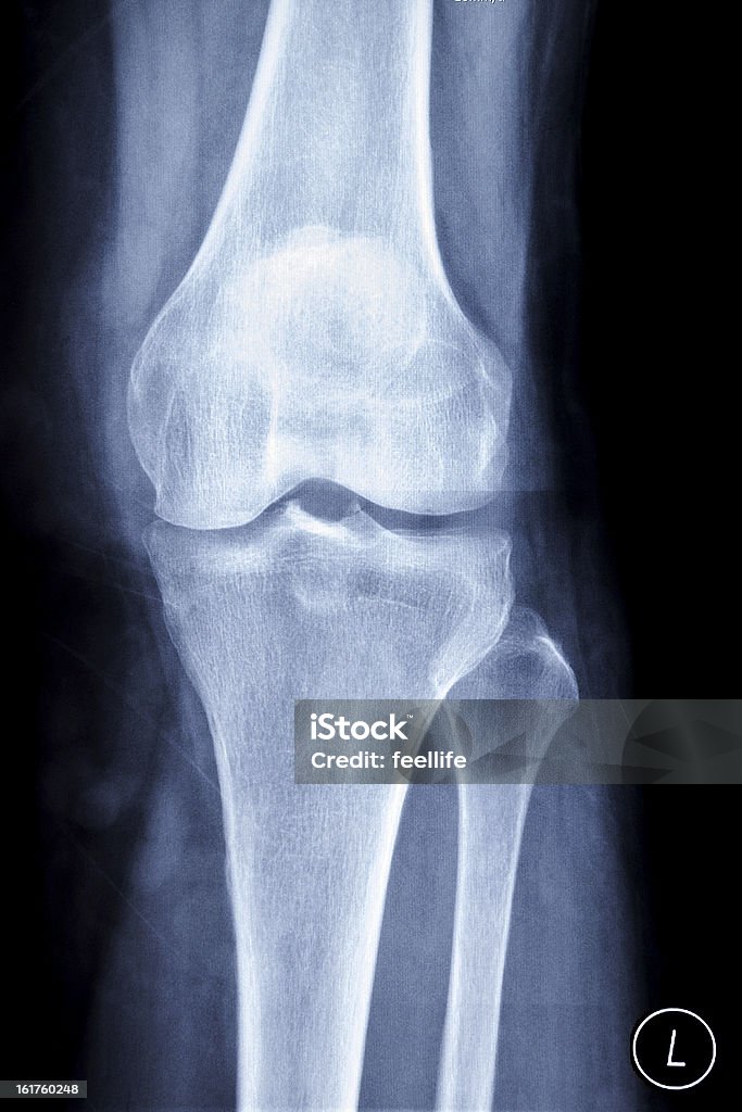 La radiografía de la rodilla - Foto de stock de Artritis libre de derechos