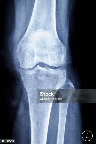 La Radiografía De La Rodilla Foto de stock y más banco de imágenes de Artritis - Artritis, Imagen de rayos X, Rayos X