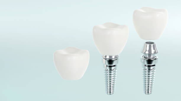 istock 3d rendering of tooth implants with ceramic crowns on color background, Modern dental surgery concept 1618418810