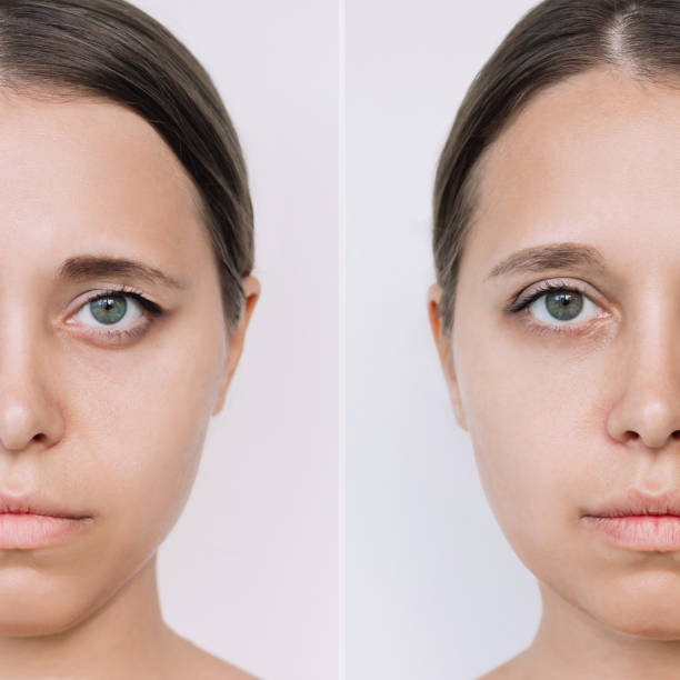 istock Young caucasian woman's face with drooping upper eyelid before and after blepharoplasty. Comparison 1618806024