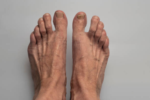 istock nail fungus infection 1619488854