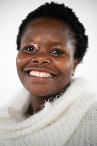 Studio portrait of beautiful African woman with slight vitiligo  highlighting her eyes
