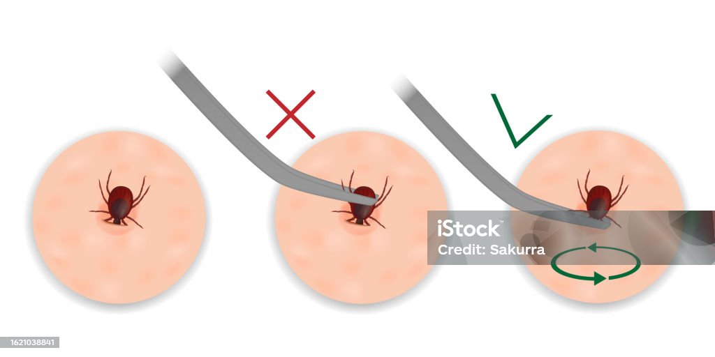 Instructions For Removing A Tick With Tweezers Extraction Of Mites Tick instructions-for-removing-a-tick-with-tweezers-extraction-of-mites-tick