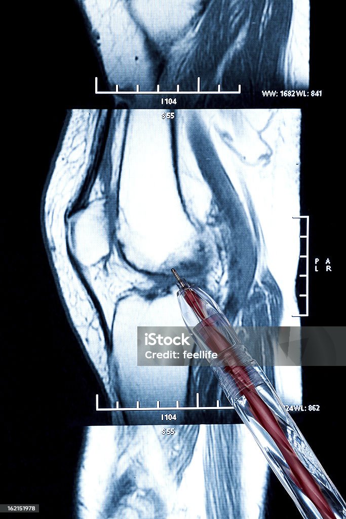 Stylo sur le genou MRI-dommages de cross et Ménisque - Photo de Docteur libre de droits