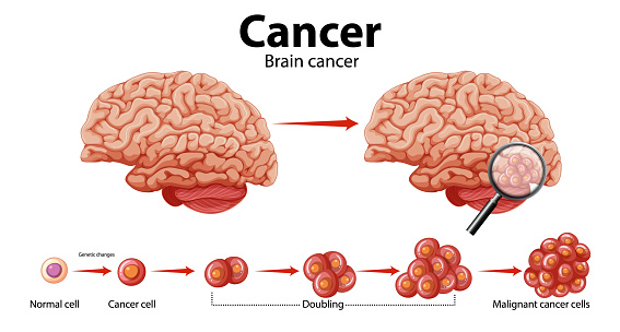Illustrated guide to brain cancer and abnormal cell growth