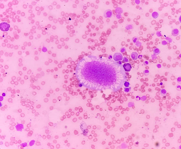 istock Acute leukemia, ALL(Acute lymphoblastic leukemia), peripheral blood smear. abnormal hematological blood cell. Bone marrow study. 1622174175