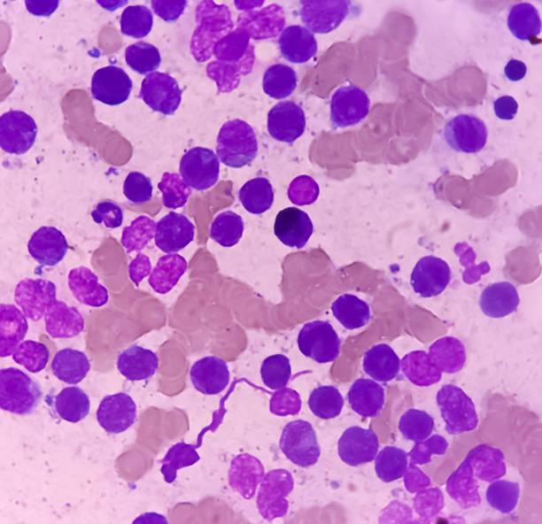 istock Acute leukemia, ALL(Acute lymphoblastic leukemia), peripheral blood smear. abnormal hematological blood cell. Bone marrow study. 1622174206