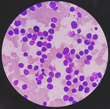Leukemia Example Acute Leukemia All Peripheral Blood Smear Abnormal Hematological Blood ...