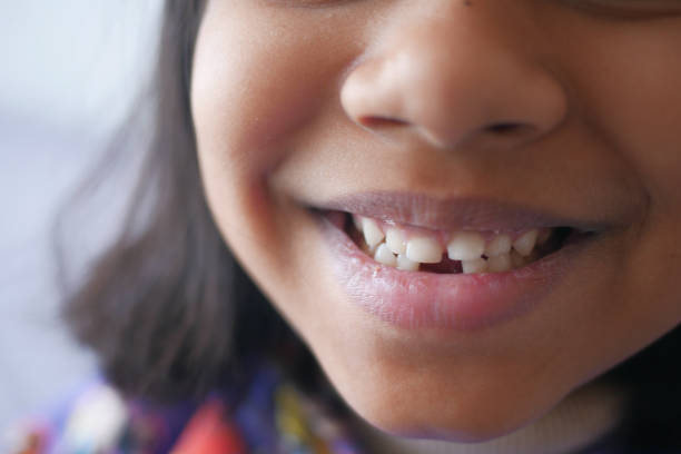 istock detail shot of child with teeth missing 1622684738