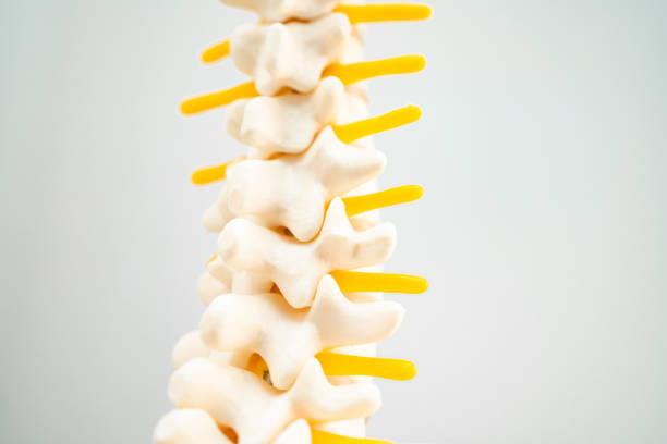 lumbar spine displaced herniated disc fragment, spinal nerve and bone. model for treatment medical in the orthopedic department. - human spine chiropractic adjustment backache human bone imagens e fotografias de stock