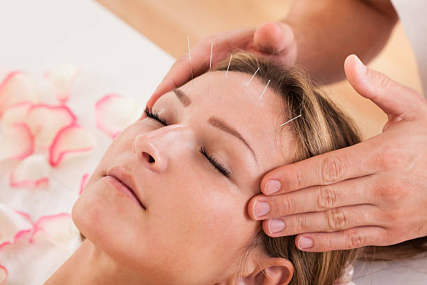 Woman undergoing acupuncture treatment and a massage  Woman undergoing acupuncture treatment with a line of fine needles inserted into the skin of her forehead acupuncture photos stock pictures, royalty-free photos & images