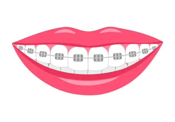 Vector illustration of Orthodontic concept vector illustration. Dental braces in flat design on white background.