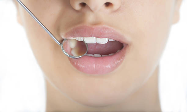 istock Beautiful smile with dental mirror 162493539