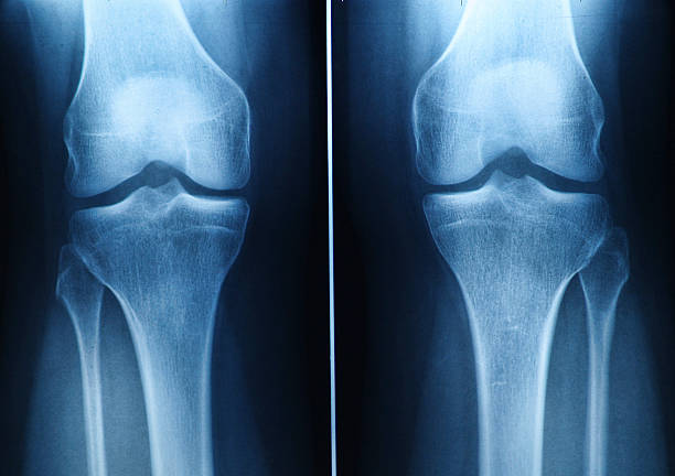 rtg kolana - x ray human knee orthopedic equipment human bone zdjęcia i obrazy z banku zdjęć