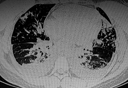 Chest CAT SCAN of multiple infections of lungs. Bilateral pleural effusion.