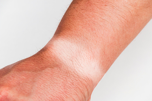 Close-up of the wrist of an unrecognizable human arm with a tanned watch mark or having sunbathed during the summer over white background.