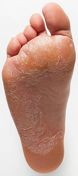 水虫 - human foot barefoot sole of foot human toe ストックフォトと画像