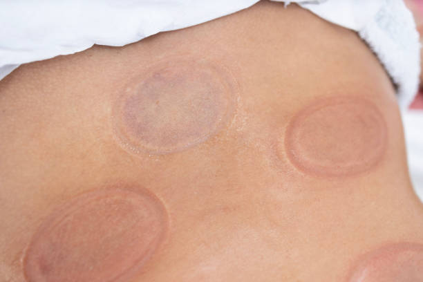 vue rapprochée des marques de ventouses de hijama sur le corps après le traitement. - beautiful the human body body care close up photos et images de collection