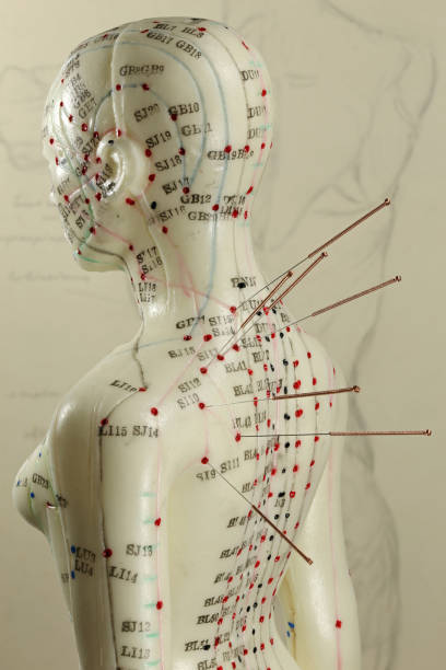 istock female acupuncture model with needles in the shoulder 1626910700