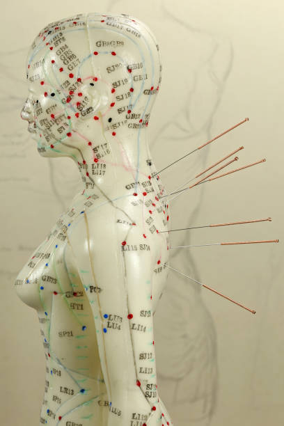 肩に針を持つ女性の鍼治療モデル - acupoints ストックフォトと画像