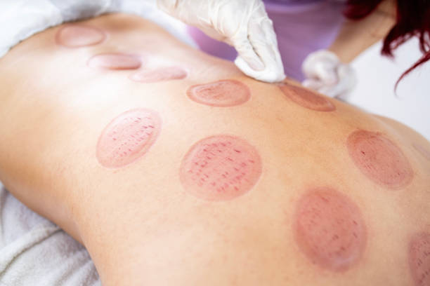 istock Wet cupping marks and cuts on patient after hijama treatment. 1627262444