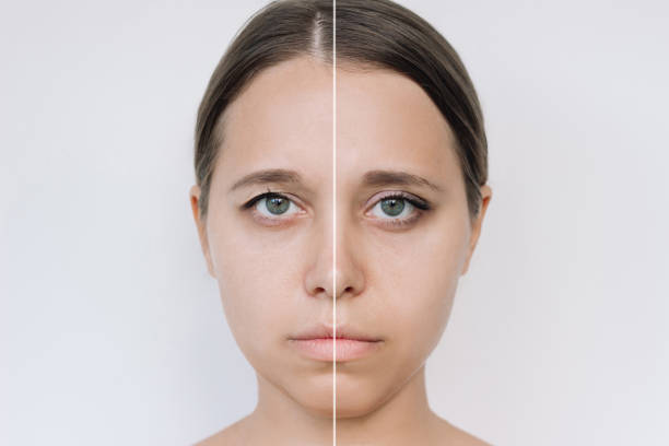 istock Young pretty caucasian woman's face with drooping upper eyelid before and after blepharoplasty 1629649287