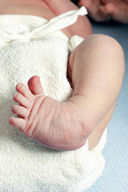 clubfoot nahaufnahme eines neugeborenen - baby beauty beautiful the human body stock-fotos und bilder