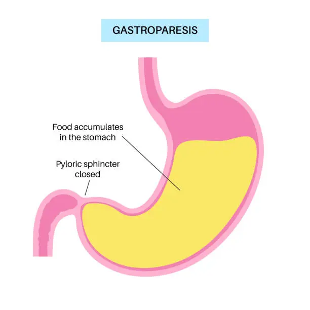 Vector illustration of Gastroparesis anatomical poster