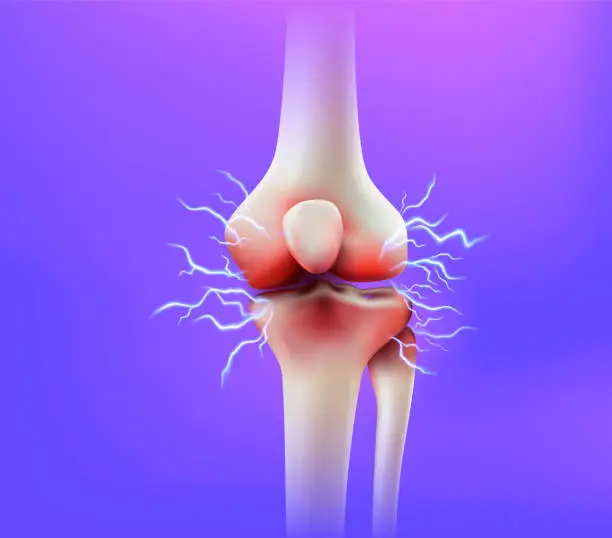 Vector illustration of Knee joint pain and tendon problems