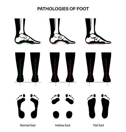 Foot pathologies anatomical poster. Flat, normal and hollow feet conditions. Abnormal feet arch, supination and overpronation. Ankle pathology diagnostic in podiatry clinic medical vector illustration