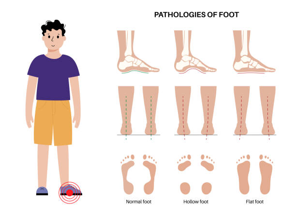 Foot pathologies poster Foot pathologies anatomical poster. Flat, normal and hollow feet conditions. Abnormal feet arch, supination and overpronation. Ankle pathology diagnostic in podiatry clinic medical vector illustration pes planus stock illustrations