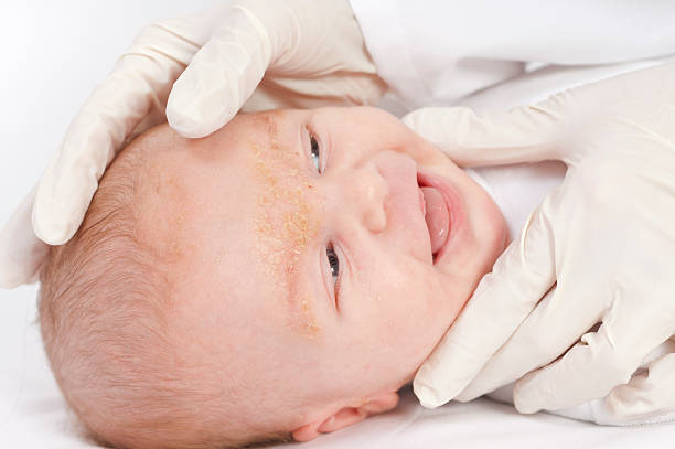 bébé avec parakératose séborrhéïque - weis photos et images de collection