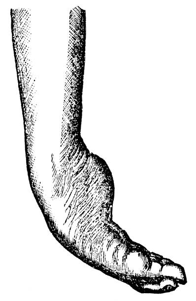 медицинская иллюстрация человеческой с�топы с талипами (косолапостью) типа equinovarus (ходьба на носке) с аддуктом (голубиный палец) - 19 век - equinus stock illustrations