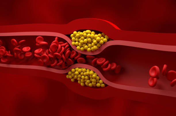 Partly blocked vessel in high level of LDL (bad cholesterol) lipoprotein – isometric view 3d illustration stock photo
