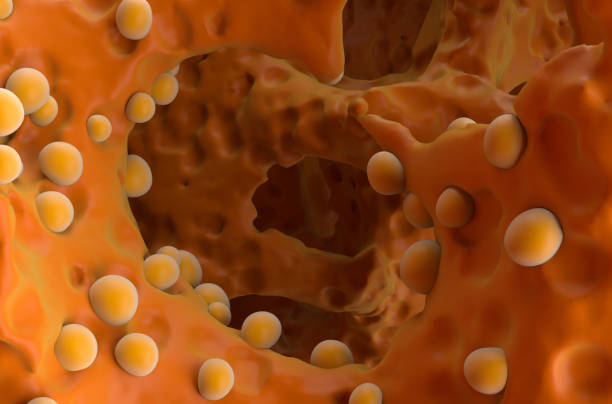 istock Bone cancer (osteosarcoma) - closeup view 3d illustration 1633111934
