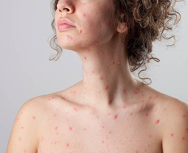 chickenpox varicella zoster virus Woman with chickenpox (varicella zoster virus). pox stock pictures, royalty-free photos & images